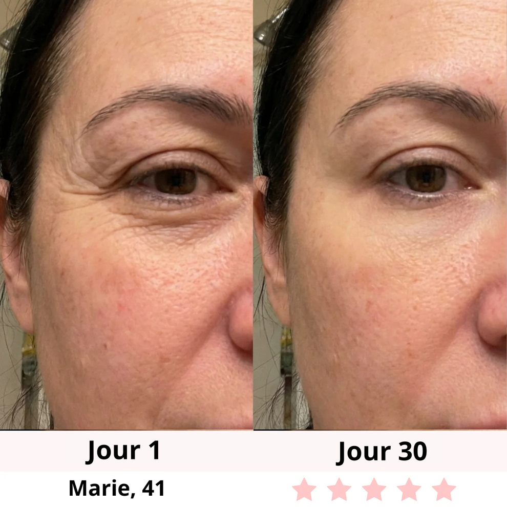 Avant / après rides des yeux